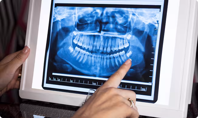 A dental X-ray displayed on a lightbox shows a full set of teeth. A person is pointing at a specific tooth, suggesting analysis or diagnosis.